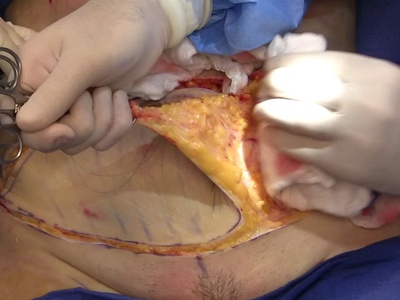 Abdominoplasty (Tummy Tuck)