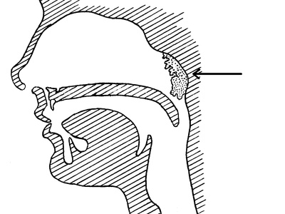 Adenoidectomy