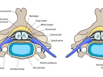 Anterior Cervical Discectomy and Fusion (ACDF)
