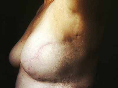 Breast Reconstruction