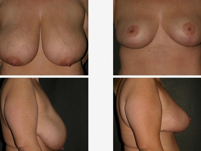 Breast Reduction (Reduction Mammoplasty)