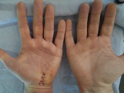 Carpal Tunnel Release