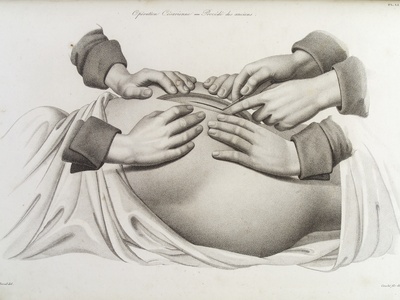 Cesarean Section (C-Section)