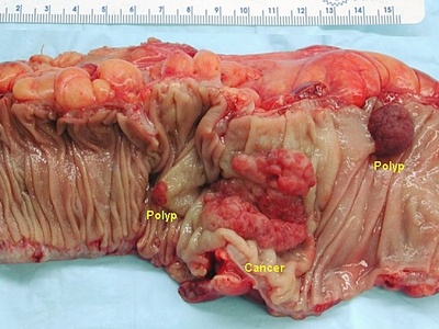 Colectomy (Colon Resection)
