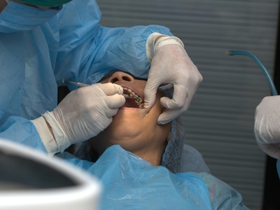 Dental Extraction (Surgical)