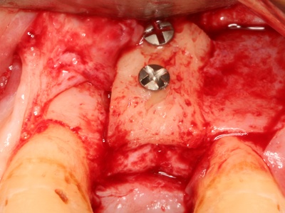 Dental Implant Surgery