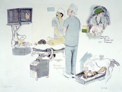 Endoscopic Polypectomy (Colon)