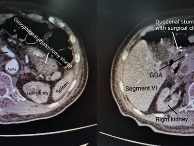 Gastrectomy (Partial/Total)