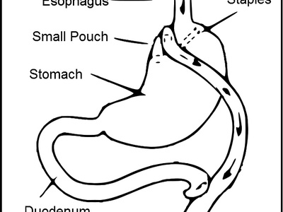 Gastric Bypass (Roux-en-Y)