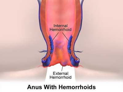 Hemorrhoidectomy