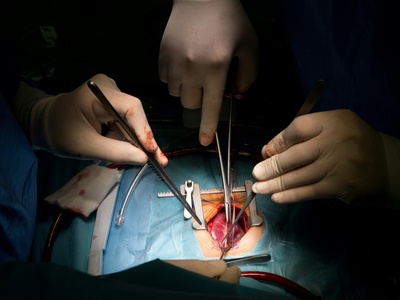 Hernia Repair (Ventral/Incisional)
