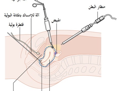 Hysterectomy