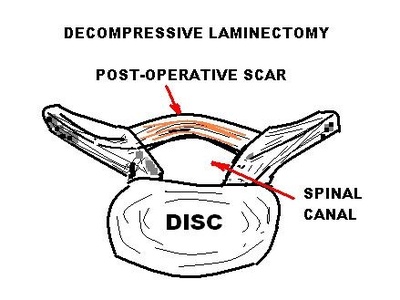 Laminectomy