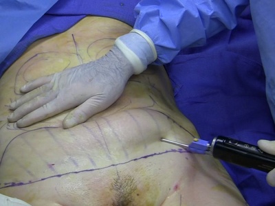 Liposuction