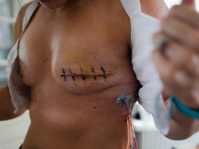 Mastectomy