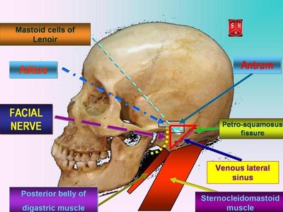 Mastoidectomy