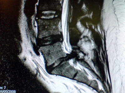 Microdiscectomy