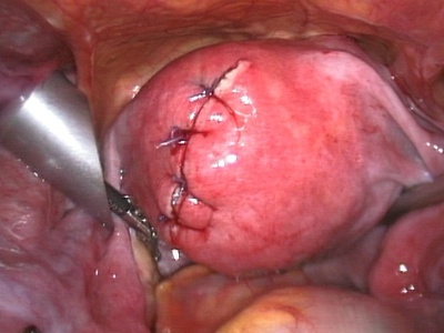 Myomectomy