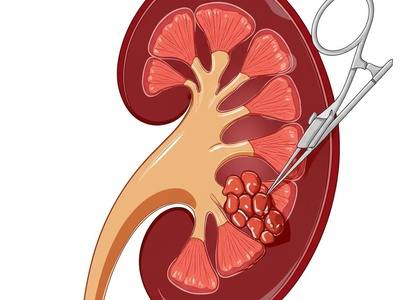 Nephrectomy (Partial/Total)