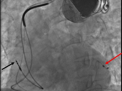 Pacemaker/ICD Implantation
