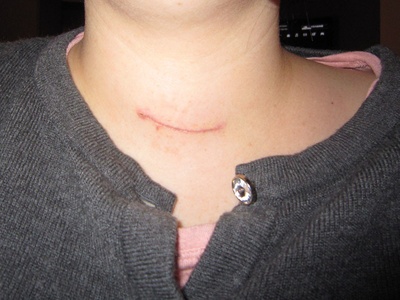 Parathyroidectomy