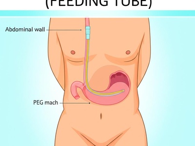 PEG Tube Placement (Feeding Tube)