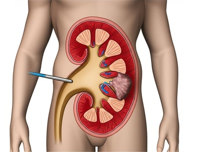 Percutaneous Nephrolithotomy (PCNL)