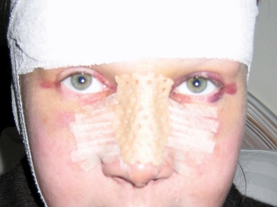 Rhinoplasty