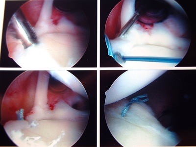Rotator Cuff Repair