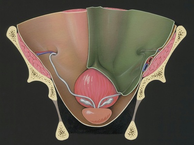 Salpingectomy