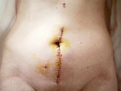 Skin Excision and Closure (e.g., cancer removal)