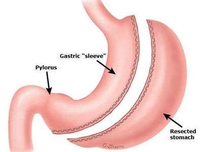 Sleeve Gastrectomy