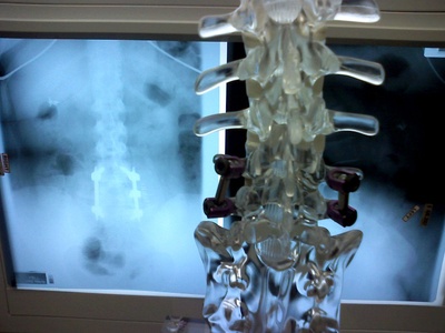 Spinal Fusion