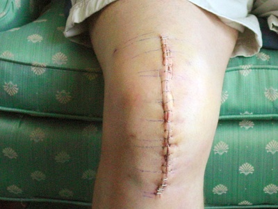 Total Knee Replacement