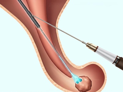 Ureteroscopy with Laser Lithotripsy