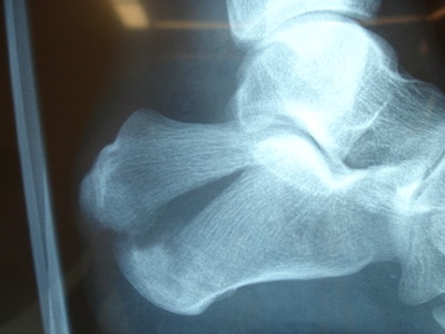 Calcaneus