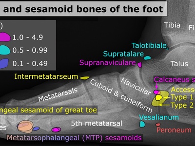 Lateral sesamoid (hallux)