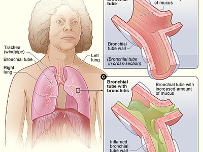 Bronchitis