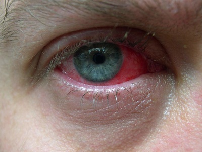 Conjunctivitis