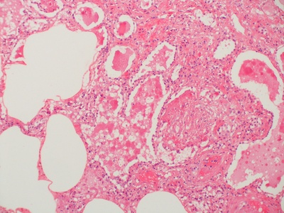 Fibrinous inflammation