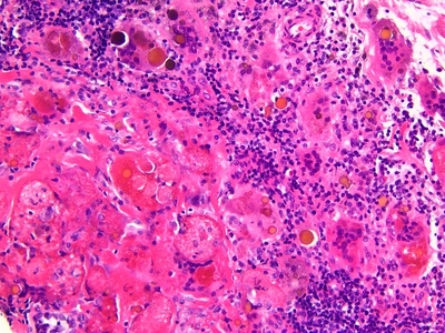 Granulomatous inflammation