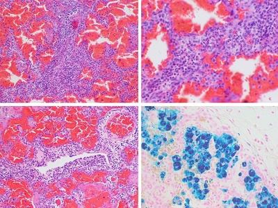 Hemorrhagic inflammation