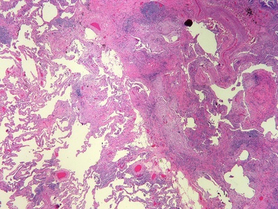 Interstitial inflammation