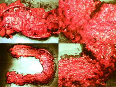 Large intestine (Colon)