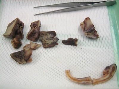 Necrotizing (gangrenous) inflammation