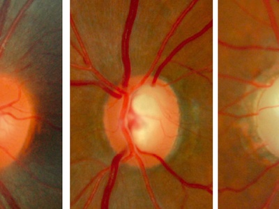 Optic nerve