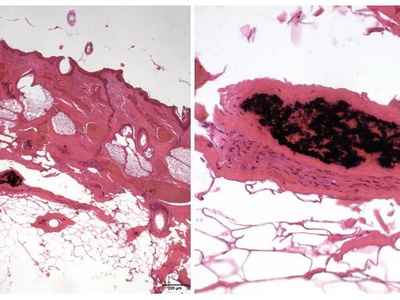 Perivascular inflammation