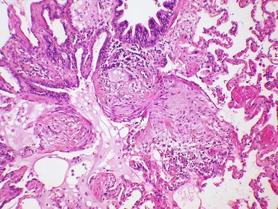 Pneumonitis/interstitial pneumonitis