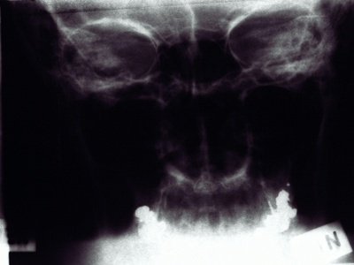 Total hip replacement