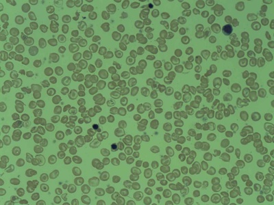Beta-thalassemia